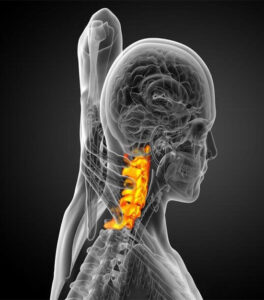 Cervical spinal canal stenosis