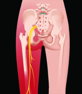 Sciatica