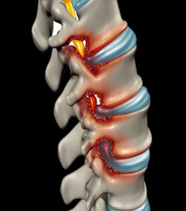 degenerative-disc-disease