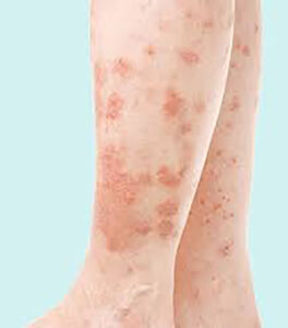 psoriasis