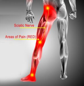 Sciatica Treatment in kphb hyderabad